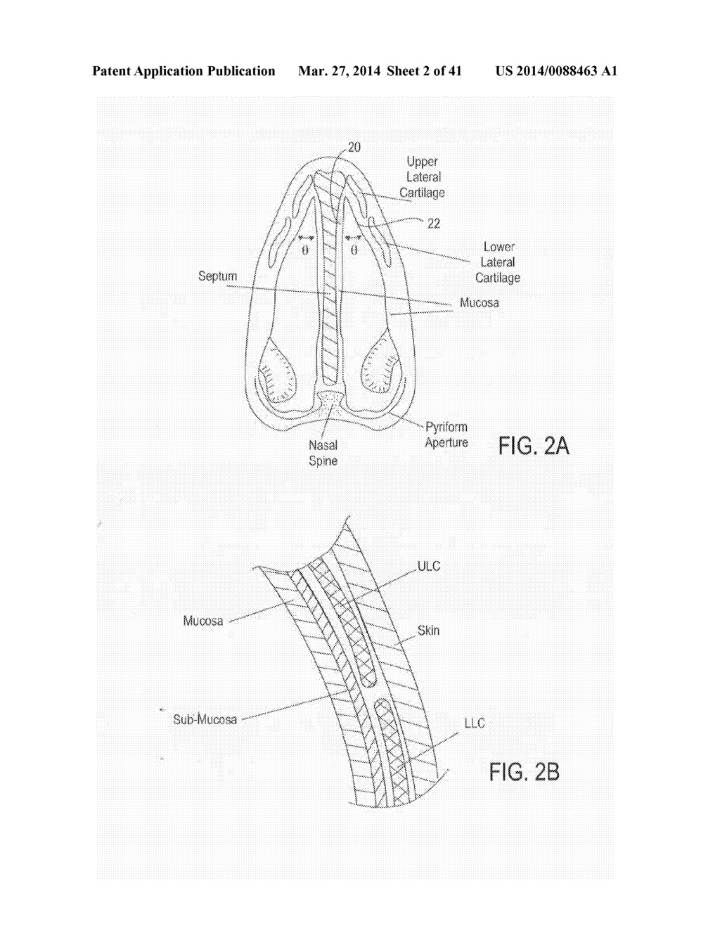 METHODS AND DEVICES TO TREAT NASAL AIRWAYS - diagram, schematic, and image 03