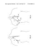 Methods and Apparatus for Inserting Multi-Lumen Split-Tip Catheters Into a     Blood Vessel diagram and image