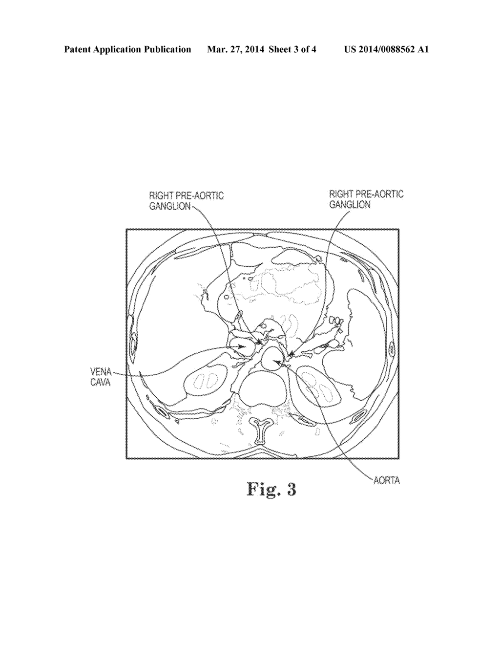 SYSTEM AND METHOD OF PRE-AORTIC GANGLION ABLATION - diagram, schematic, and image 04