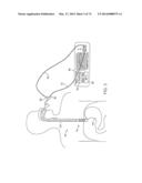 CYROGENIC TREATMENT SYSTEMS diagram and image