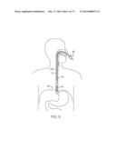 CYROGENIC TREATMENT SYSTEMS diagram and image