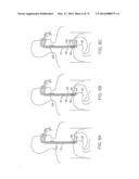 CYROGENIC TREATMENT SYSTEMS diagram and image