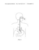 CYROGENIC TREATMENT SYSTEMS diagram and image