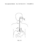 CYROGENIC TREATMENT SYSTEMS diagram and image