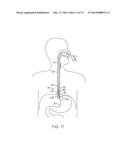 CYROGENIC TREATMENT SYSTEMS diagram and image