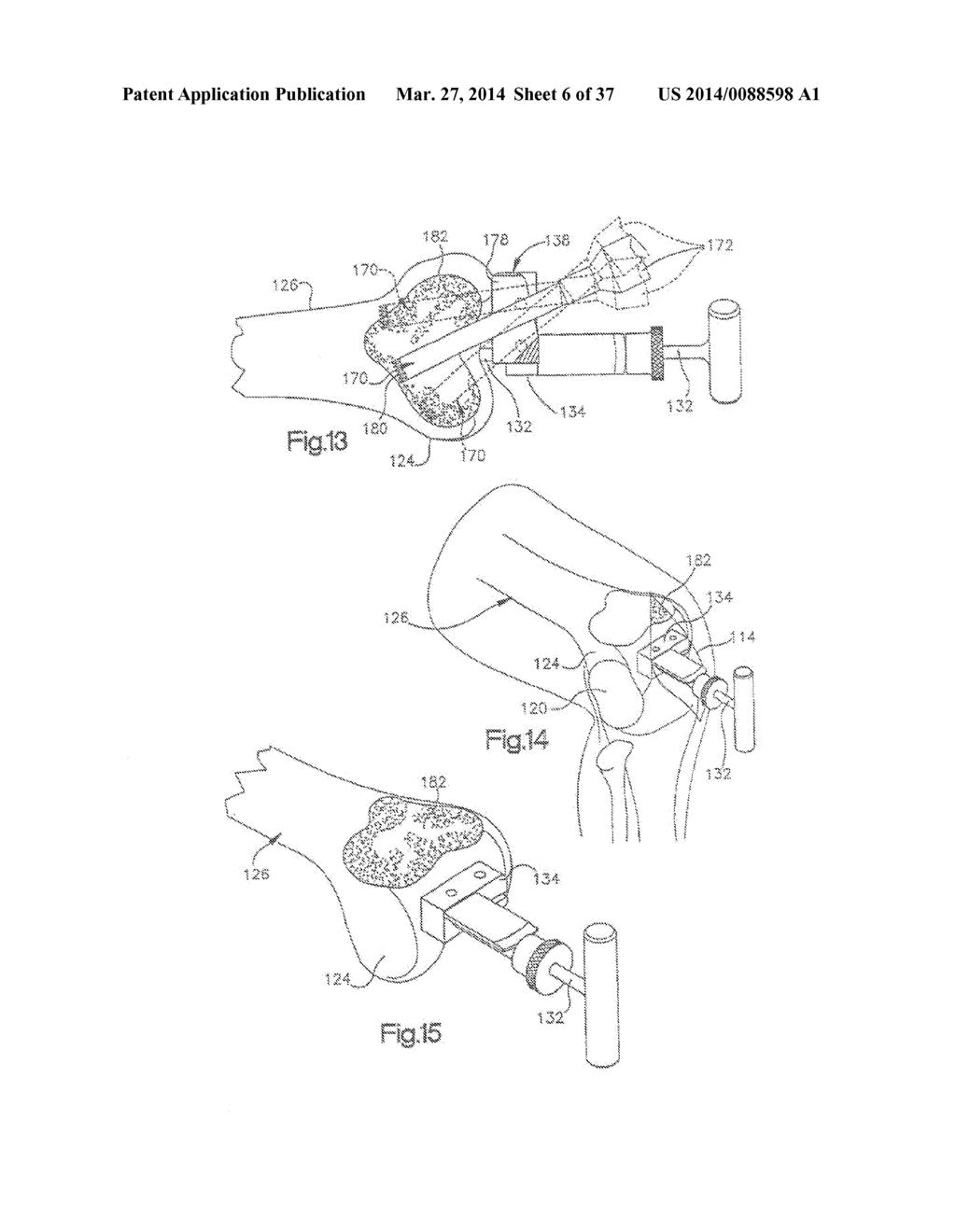 METHOD OF PREPARING A FEMUR AND TIBIA IN KNEE ARTHROPLASTY - diagram, schematic, and image 07