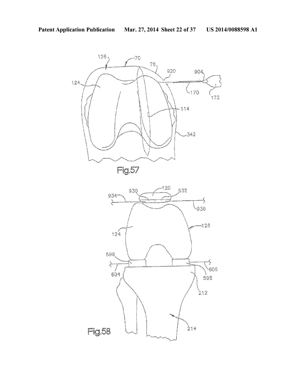 METHOD OF PREPARING A FEMUR AND TIBIA IN KNEE ARTHROPLASTY - diagram, schematic, and image 23