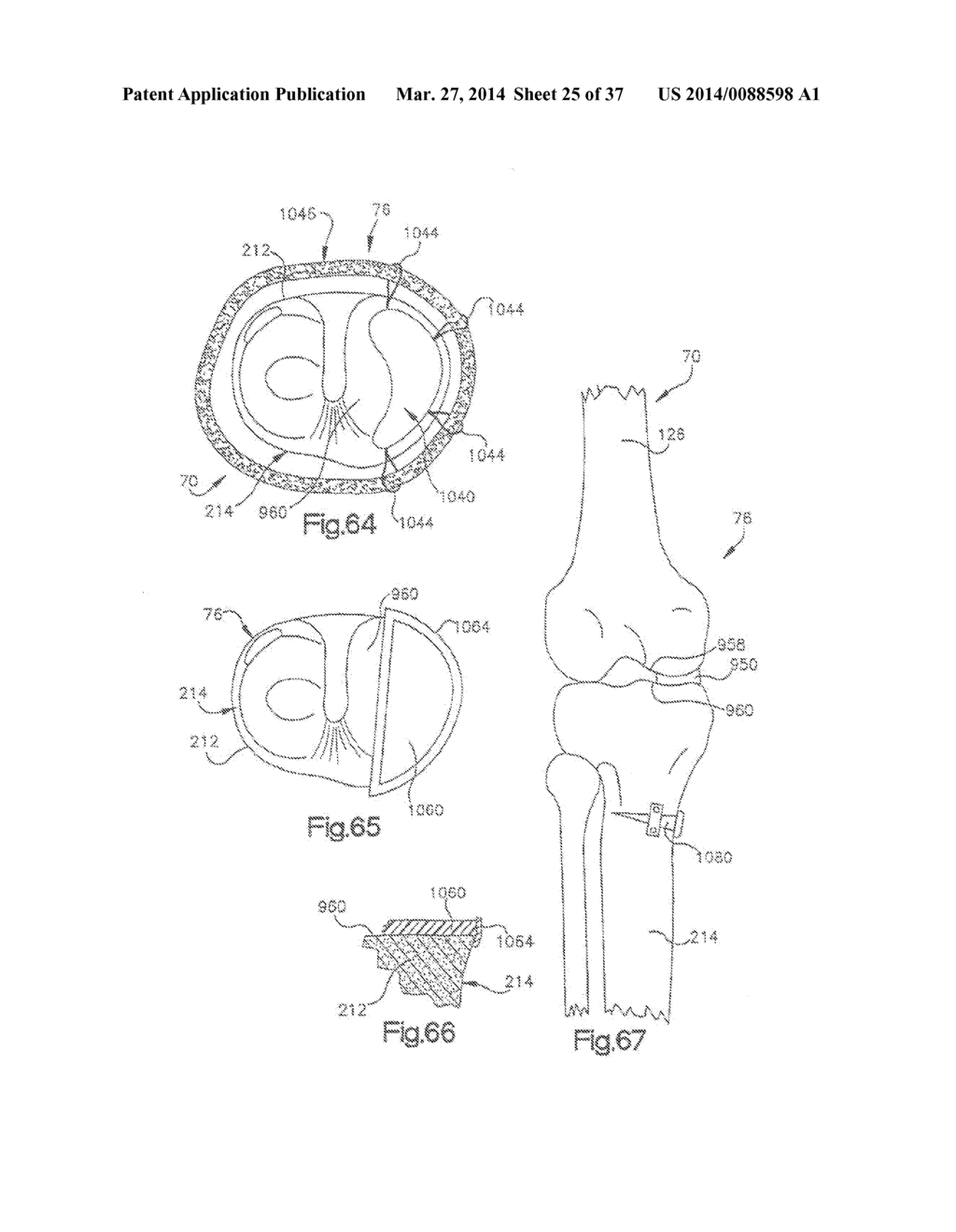 METHOD OF PREPARING A FEMUR AND TIBIA IN KNEE ARTHROPLASTY - diagram, schematic, and image 26