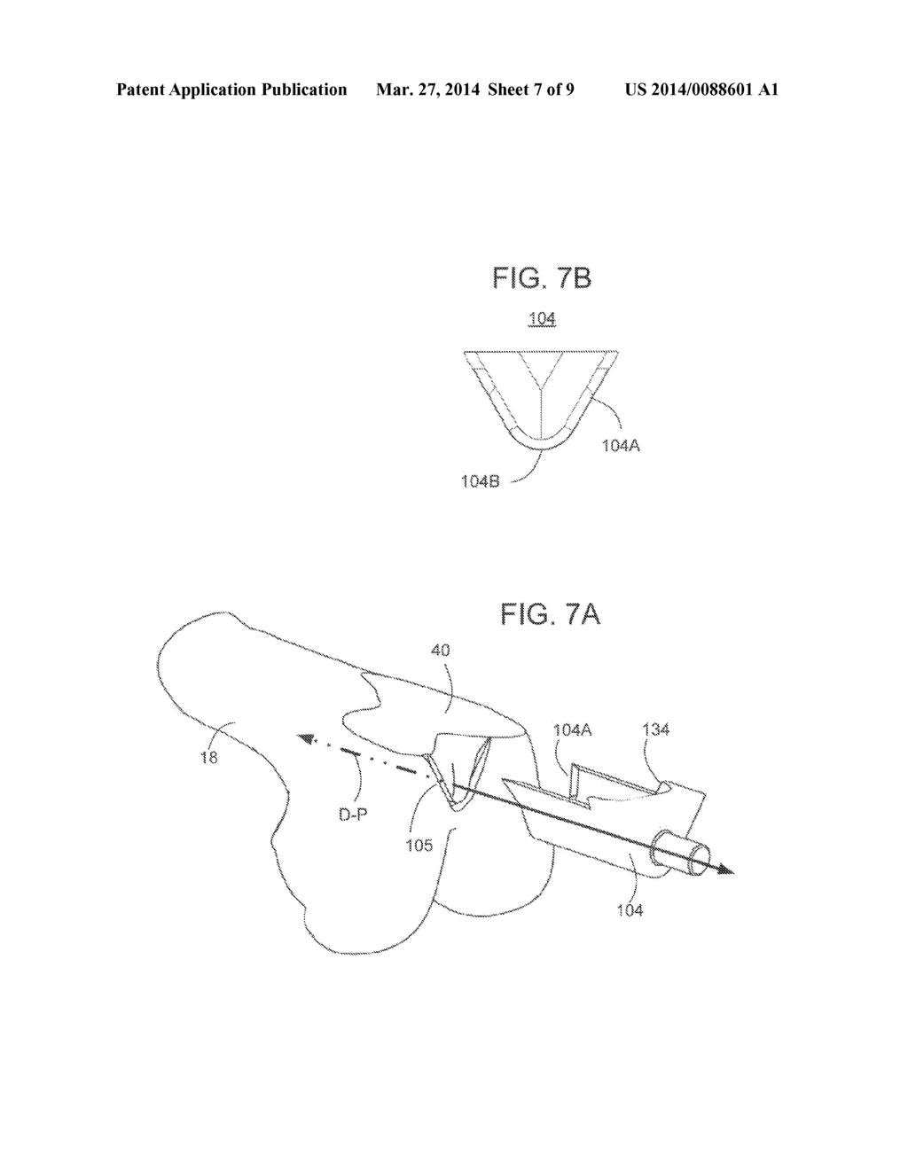 METHODS AND APPARATUS FOR PREPARING A PATIENT'S FEMUR FOR PATELLOFEMORAL     KNEE ARTHROPLASTY - diagram, schematic, and image 08