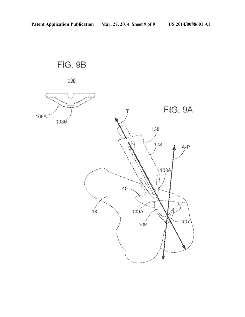 METHODS AND APPARATUS FOR PREPARING A PATIENT'S FEMUR FOR PATELLOFEMORAL     KNEE ARTHROPLASTY - diagram, schematic, and image 10