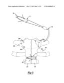 Method And Apparatus For Sternal Closure diagram and image