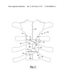 Method And Apparatus For Sternal Closure diagram and image