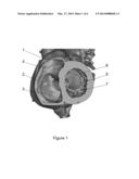 PATIENT-SPECIFIC INTRALUMINAL IMPLANTS diagram and image