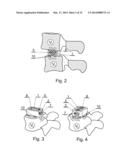 INTERVERTEBRAL IMPLANT FOR MUTUAL SITUATING OF ADJACENT VERTEBRAE diagram and image