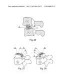 INTERVERTEBRAL IMPLANT FOR MUTUAL SITUATING OF ADJACENT VERTEBRAE diagram and image