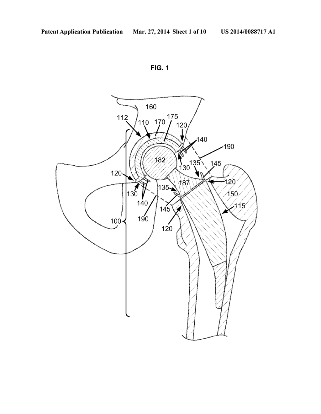 ARTIFICIAL JOINT COMPONENTS INCLUDING SYNOVIAL FLUID DEFLECTING STRUCTURES - diagram, schematic, and image 02