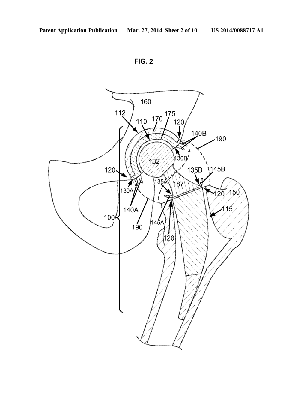 ARTIFICIAL JOINT COMPONENTS INCLUDING SYNOVIAL FLUID DEFLECTING STRUCTURES - diagram, schematic, and image 03