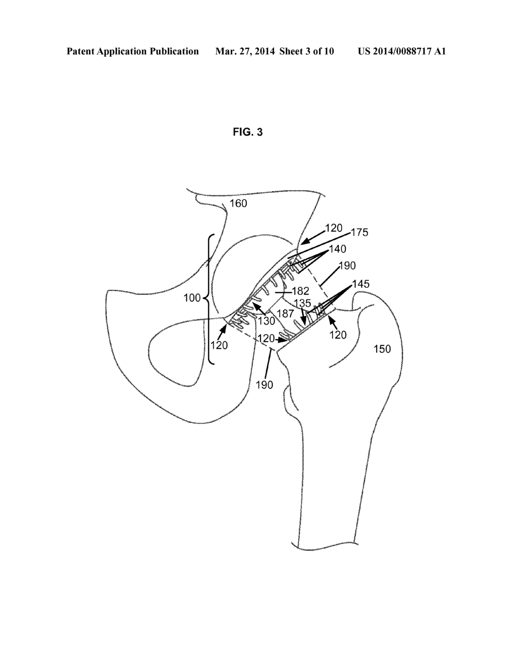 ARTIFICIAL JOINT COMPONENTS INCLUDING SYNOVIAL FLUID DEFLECTING STRUCTURES - diagram, schematic, and image 04