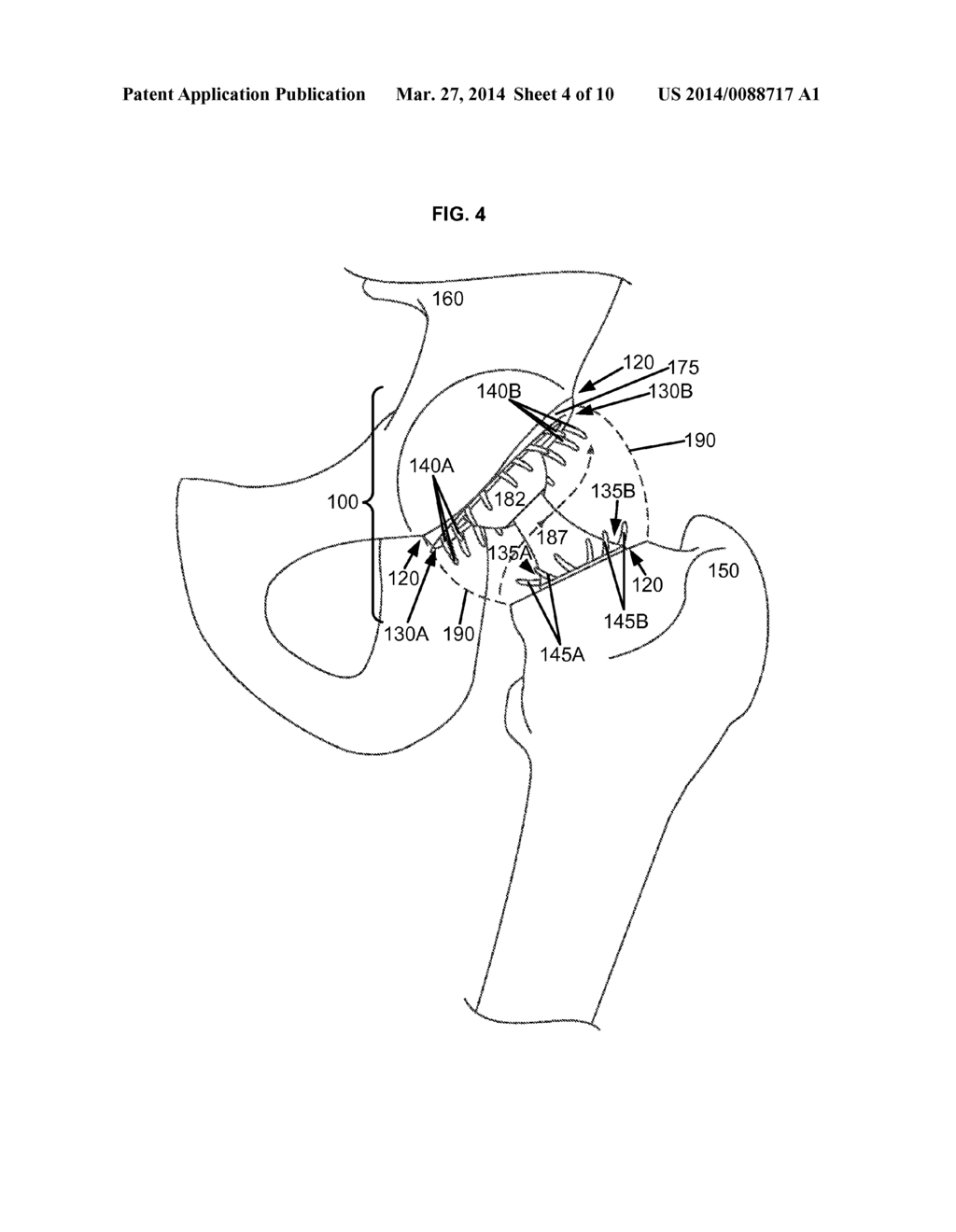 ARTIFICIAL JOINT COMPONENTS INCLUDING SYNOVIAL FLUID DEFLECTING STRUCTURES - diagram, schematic, and image 05