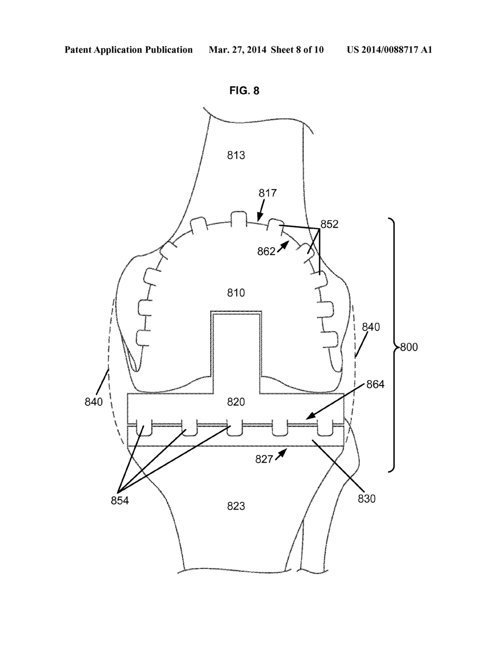 ARTIFICIAL JOINT COMPONENTS INCLUDING SYNOVIAL FLUID DEFLECTING STRUCTURES - diagram, schematic, and image 09