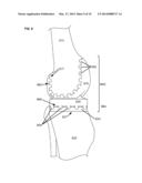 ARTIFICIAL JOINT COMPONENTS INCLUDING SYNOVIAL FLUID DEFLECTING STRUCTURES diagram and image