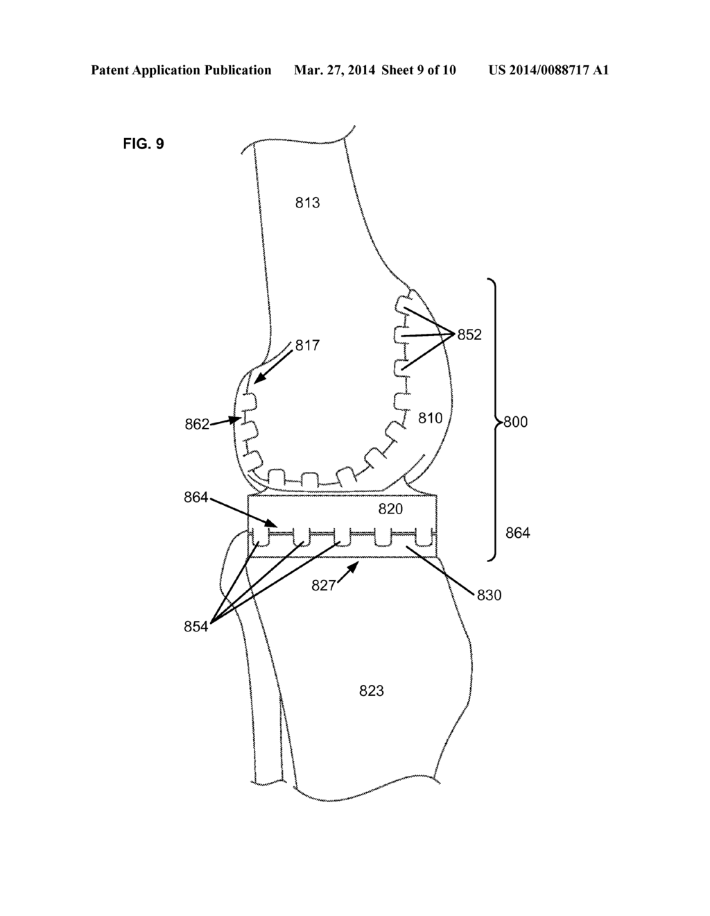 ARTIFICIAL JOINT COMPONENTS INCLUDING SYNOVIAL FLUID DEFLECTING STRUCTURES - diagram, schematic, and image 10