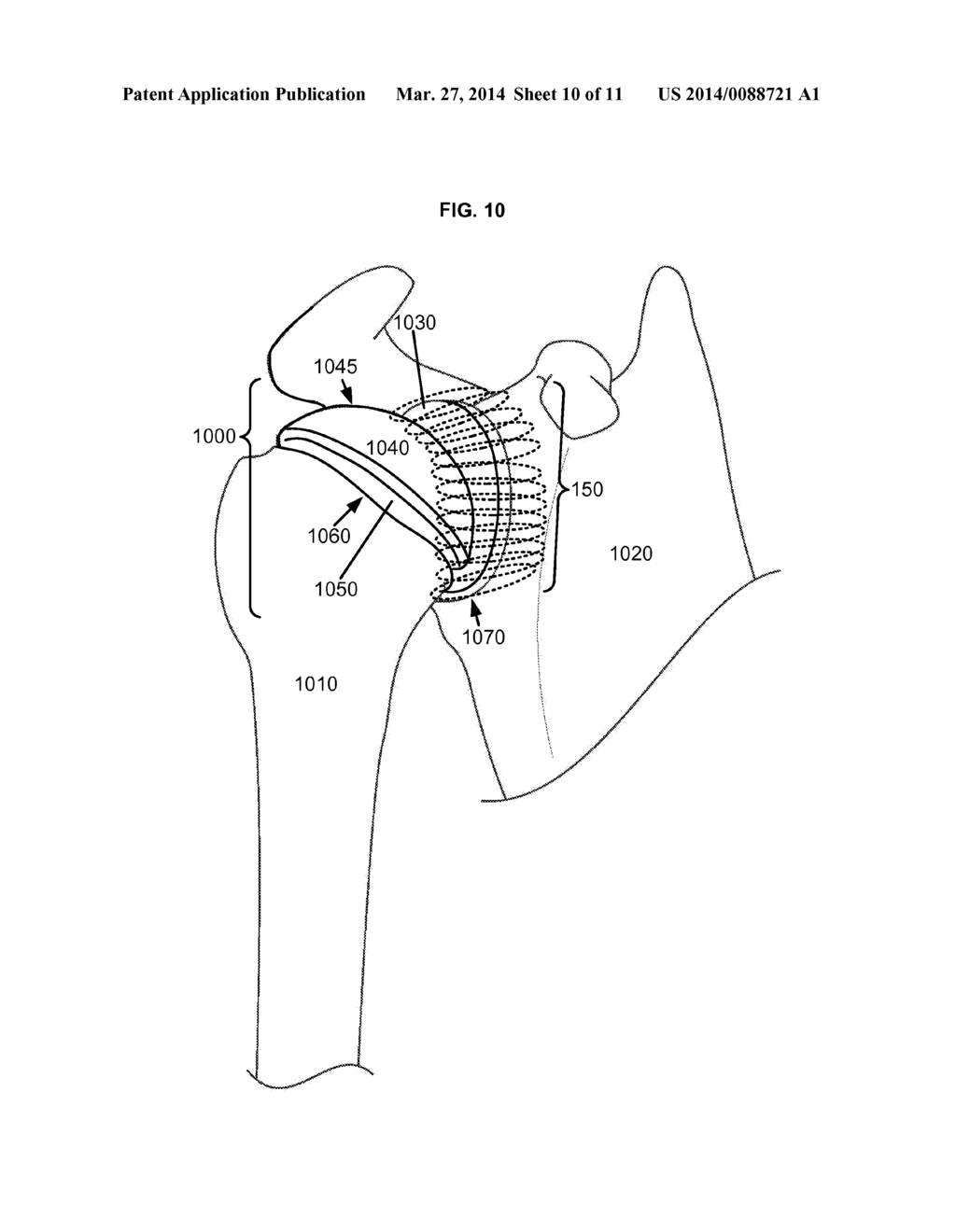 ARTIFICIAL JOINT COMPONENTS INCLUDING INTEGRAL MAGNETIC FIELDS CONFIGURED     TO DEFLECT WEAR DEBRIS PARTICLES - diagram, schematic, and image 11