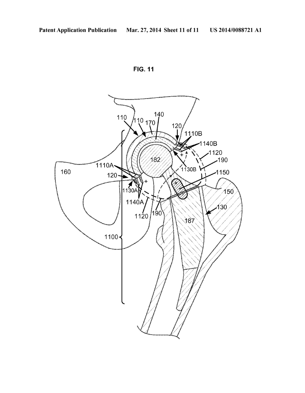 ARTIFICIAL JOINT COMPONENTS INCLUDING INTEGRAL MAGNETIC FIELDS CONFIGURED     TO DEFLECT WEAR DEBRIS PARTICLES - diagram, schematic, and image 12