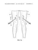 METHOD FOR TREATING AND CONFIRMING DIAGNOSIS OF EXERTIONAL COMPARTMENT     SYNDROME diagram and image