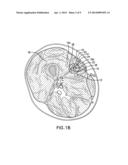 METHOD FOR TREATING AND CONFIRMING DIAGNOSIS OF EXERTIONAL COMPARTMENT     SYNDROME diagram and image