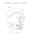 DENTAL IMPLANT POSITIONING SYSTEM diagram and image