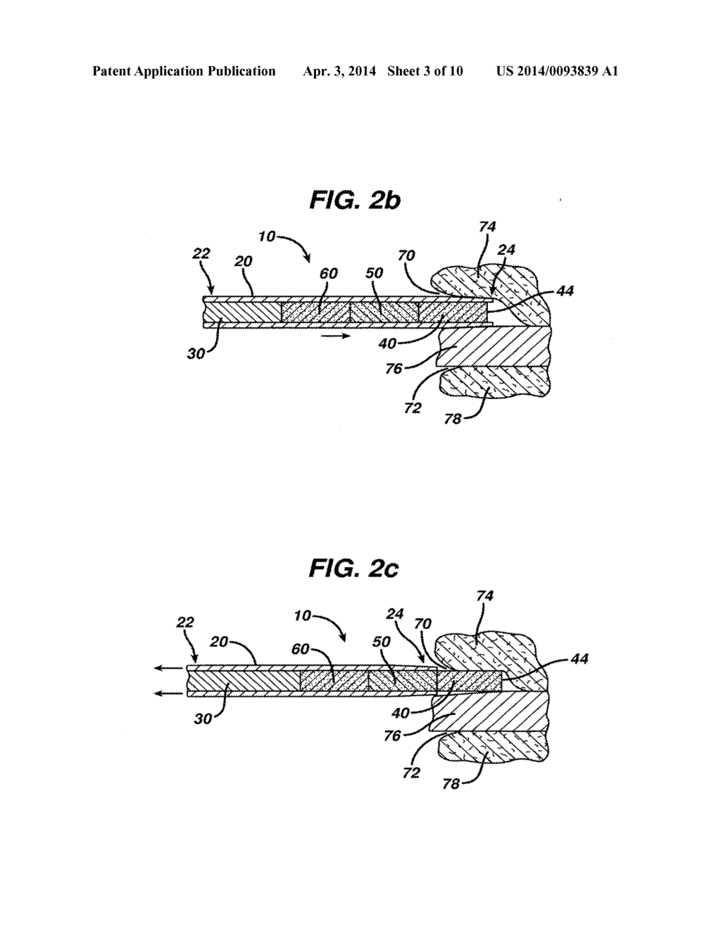 MEDICINAL IMPLANT DEVICE AND CARTRIDGE - diagram, schematic, and image 04