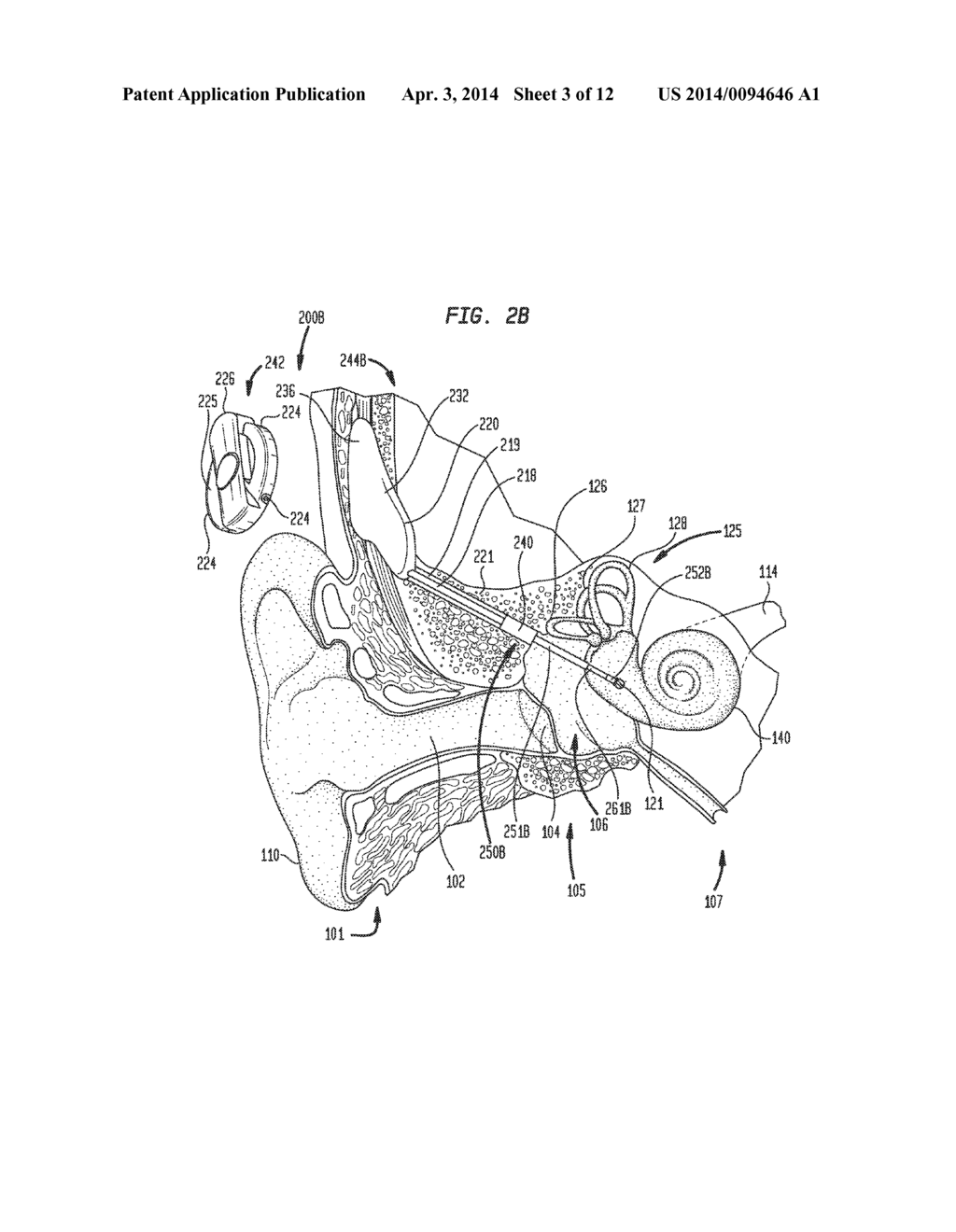 ADJUSTABLE FIXATION DEVICE HAVING REDUCED INFECTION - diagram, schematic, and image 04