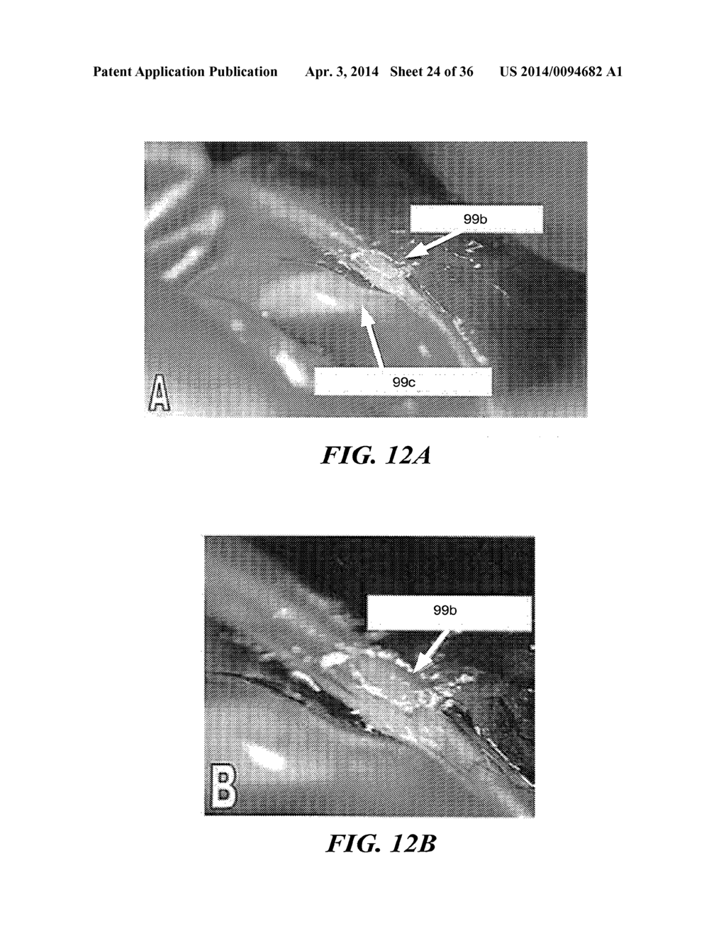 IMAGE GUIDED HIGH INTENSITY FOCUSED ULTRASOUND TREATMENT OF NERVES - diagram, schematic, and image 25