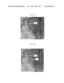 APPARATUS AND METHODS FOR DETERMINING A DIMENSION OF A PORTION OF A STACK     OF ENDOLUMINAL DATA POINTS diagram and image