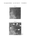 APPARATUS AND METHODS FOR DETERMINING A DIMENSION OF A PORTION OF A STACK     OF ENDOLUMINAL DATA POINTS diagram and image