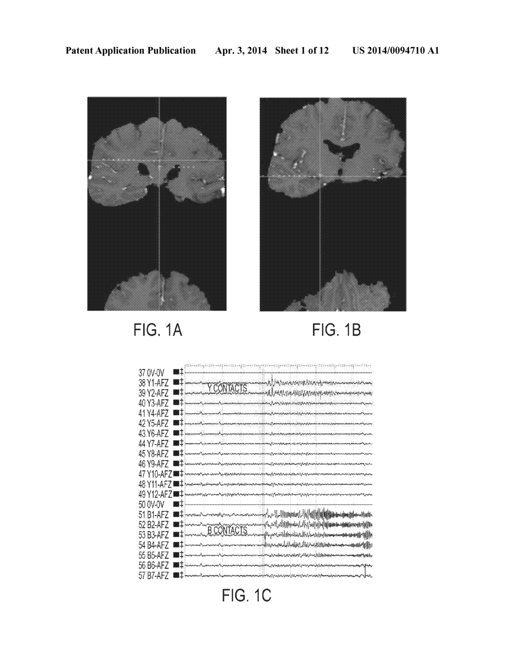 COMPUTATONAL TOOL FOR PRE-SURGICAL EVALUATION OF PATIENTS WITH MEDICALLY     REFRACTORY EPILEPSY - diagram, schematic, and image 02