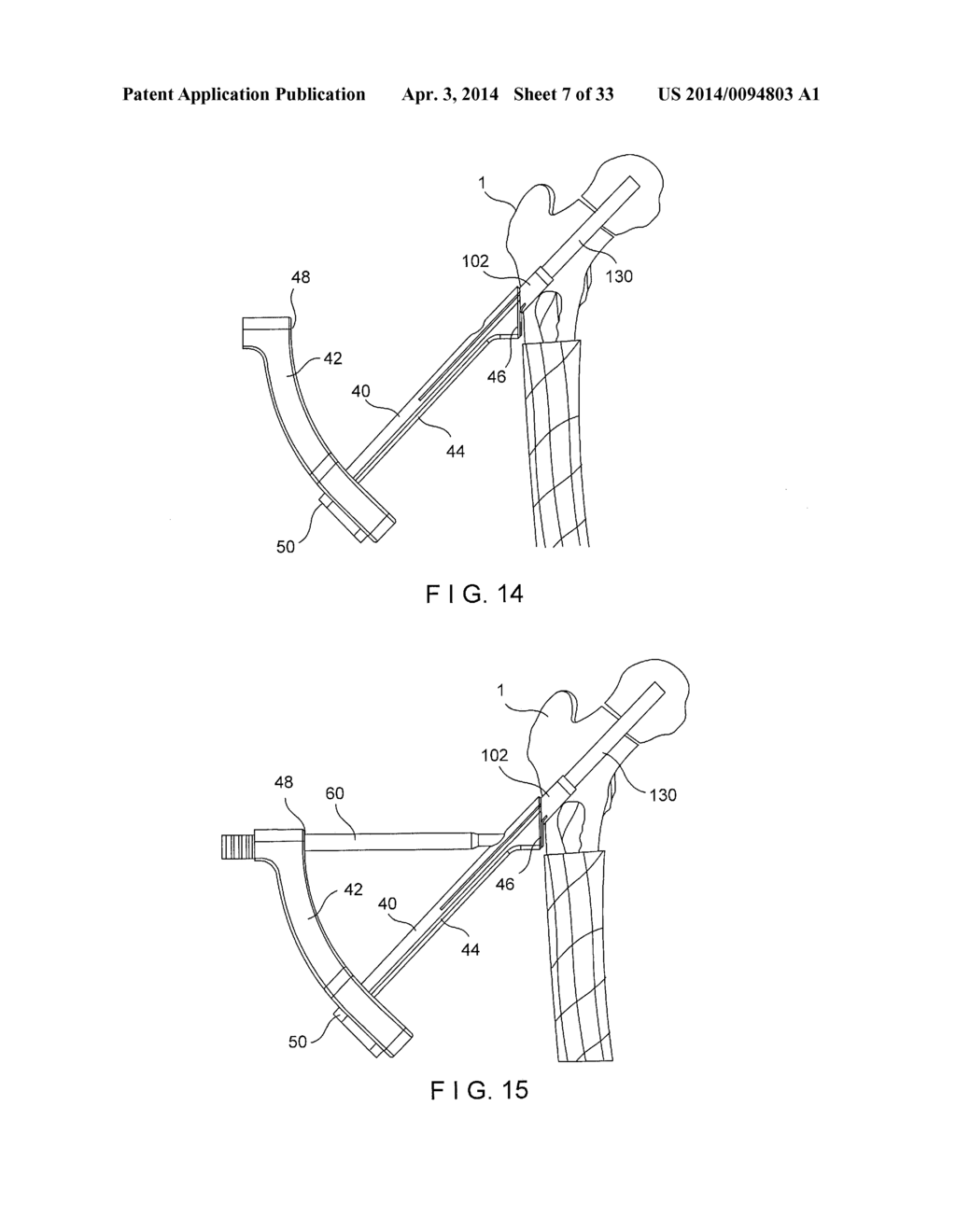 FEMORAL NECK FRACTURE IMPLANT - diagram, schematic, and image 08