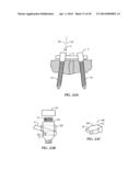 Spinal Stabilization Device diagram and image