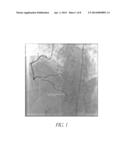 DIASTOLIC CORONARY STENT DEPLOYMENT SYSTEM FOR PRECISE BIFURCATION LESION     STENTING diagram and image