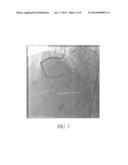 DIASTOLIC CORONARY STENT DEPLOYMENT SYSTEM FOR PRECISE BIFURCATION LESION     STENTING diagram and image