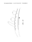 VASCULAR STENTING FOR ANEURYSMS diagram and image