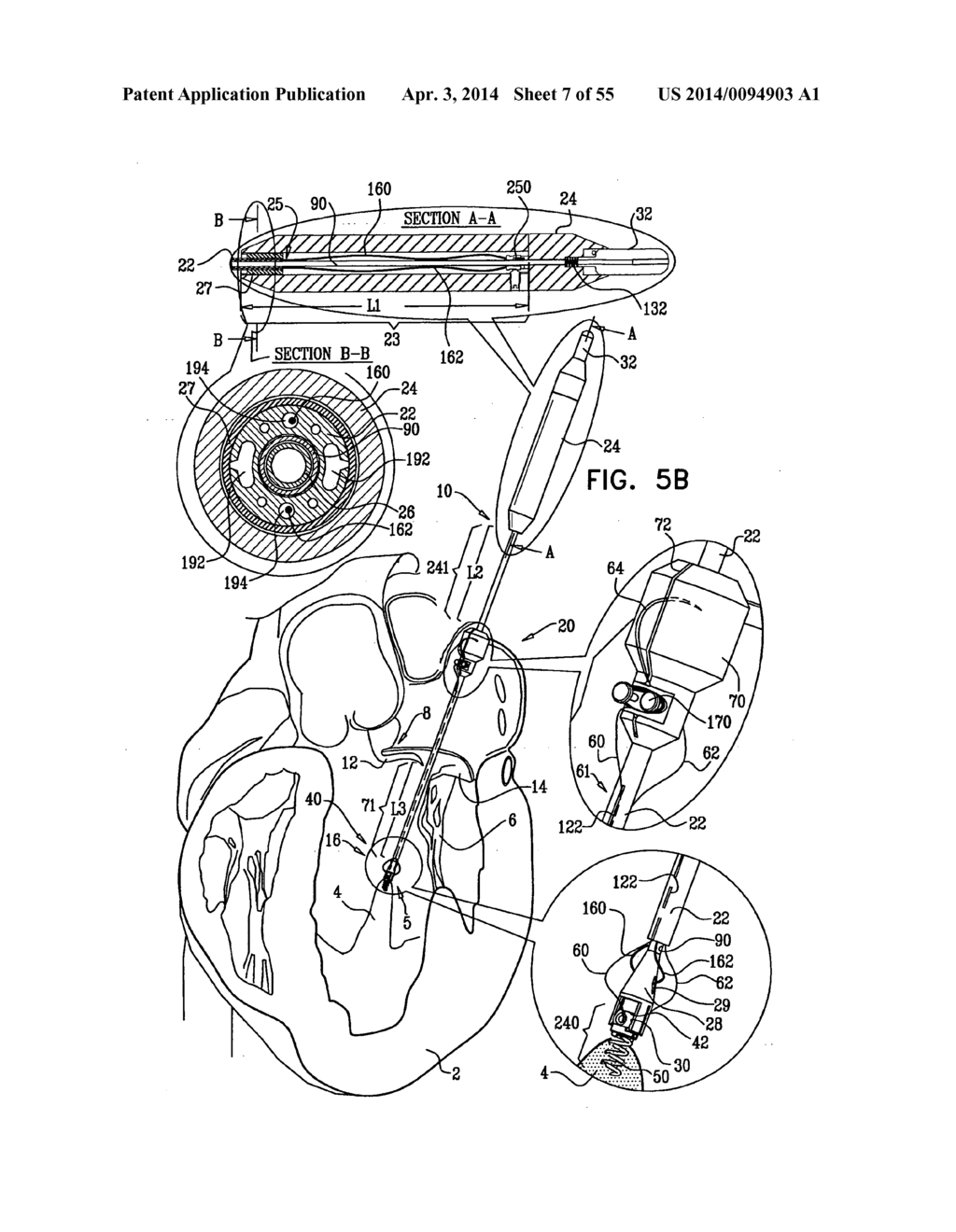 IMPLANTATION OF REPAIR CHORDS IN THE HEART - diagram, schematic, and image 08