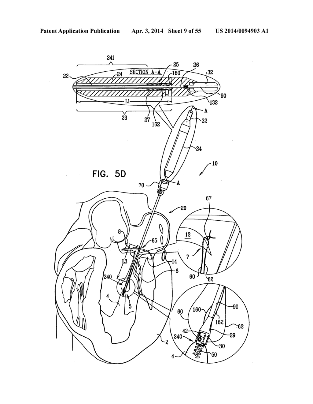 IMPLANTATION OF REPAIR CHORDS IN THE HEART - diagram, schematic, and image 10