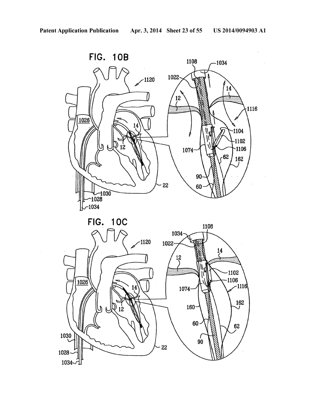 IMPLANTATION OF REPAIR CHORDS IN THE HEART - diagram, schematic, and image 24