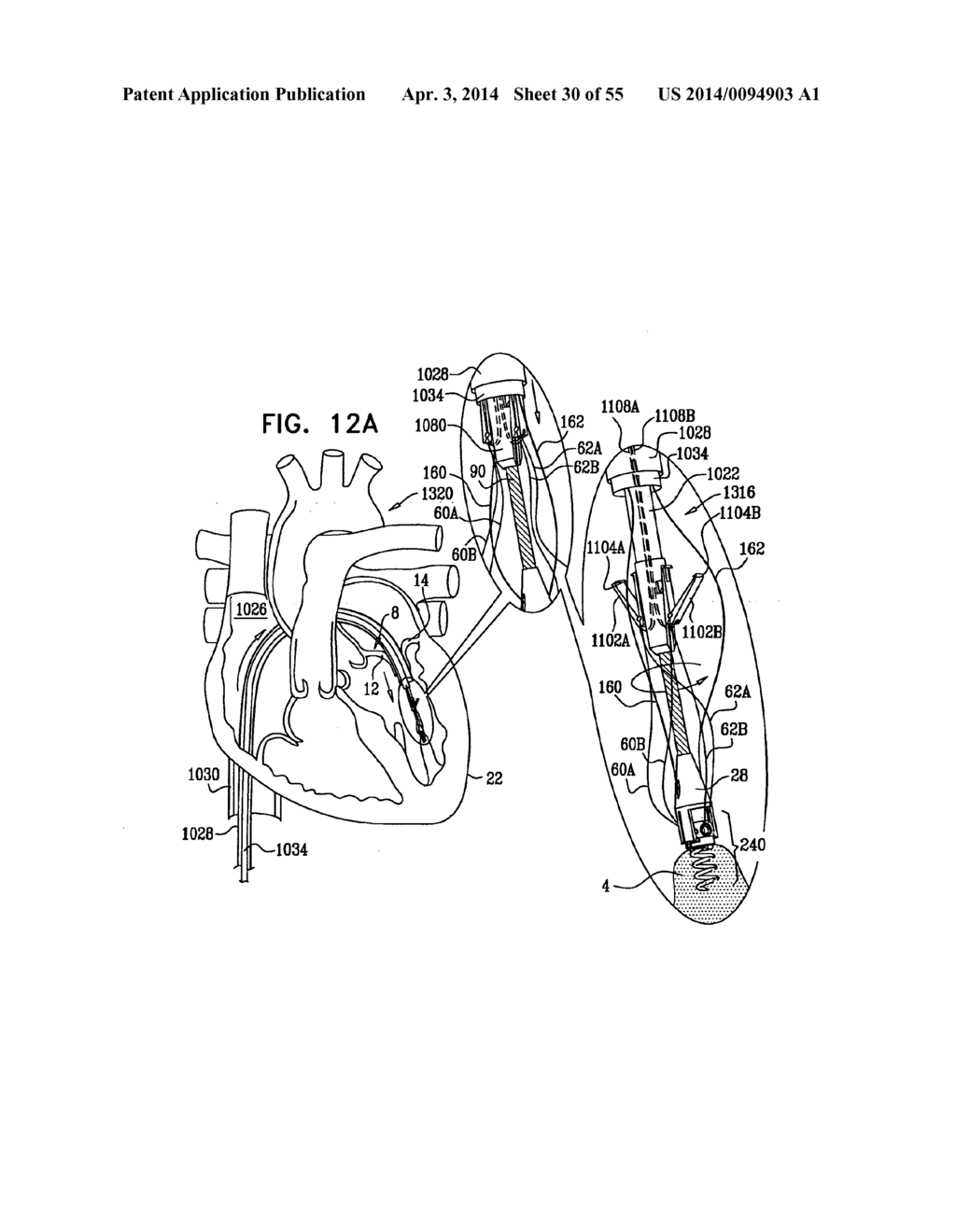 IMPLANTATION OF REPAIR CHORDS IN THE HEART - diagram, schematic, and image 31