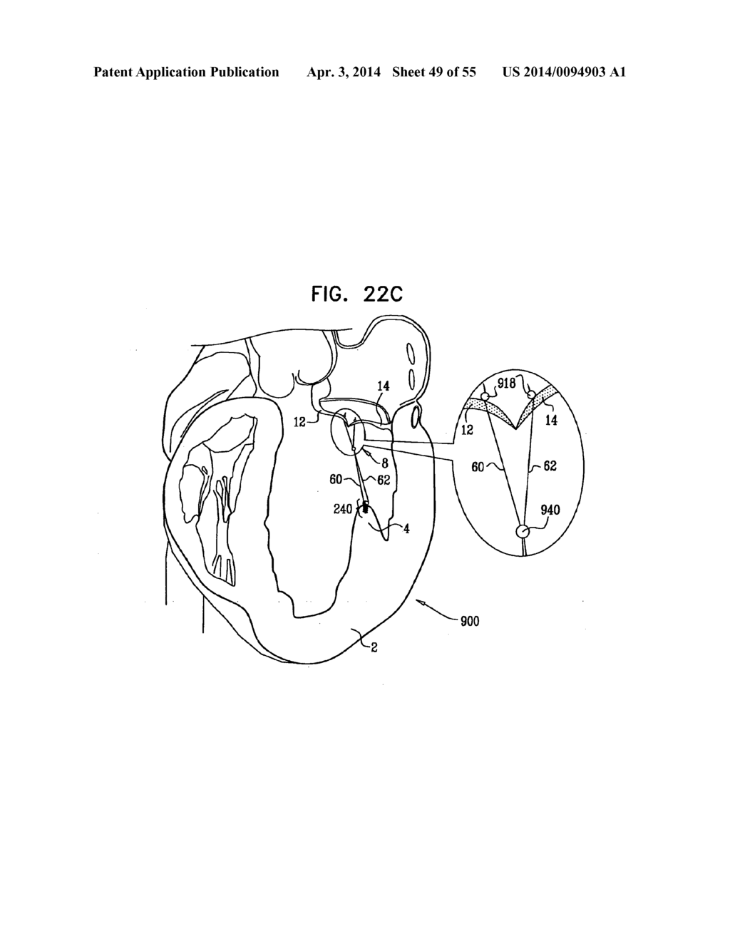 IMPLANTATION OF REPAIR CHORDS IN THE HEART - diagram, schematic, and image 50