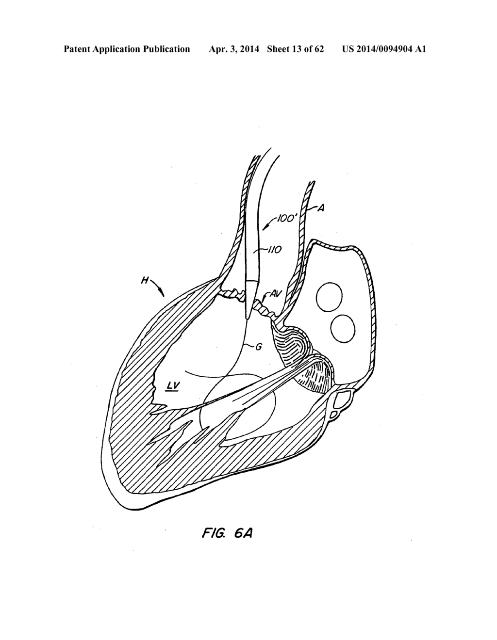 Retrievable Heart Valve Anchor and Method - diagram, schematic, and image 14