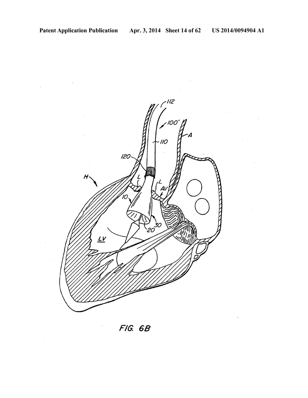 Retrievable Heart Valve Anchor and Method - diagram, schematic, and image 15