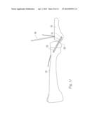 FIXATION IMPLANT AND METHOD diagram and image